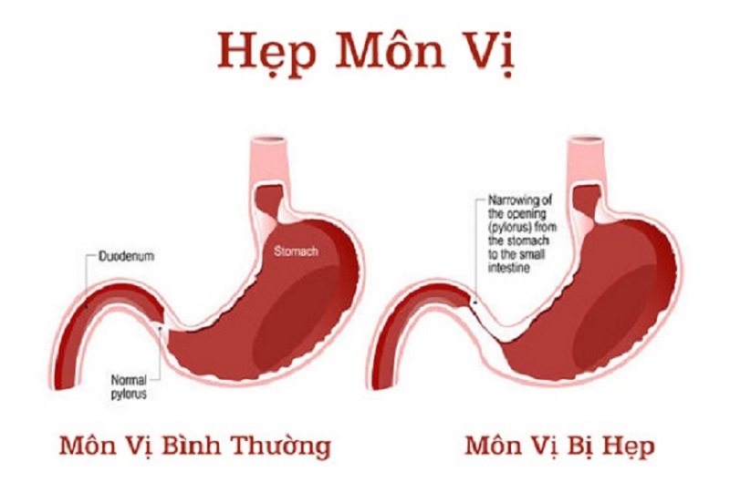 biến chứng bệnh dạ dày