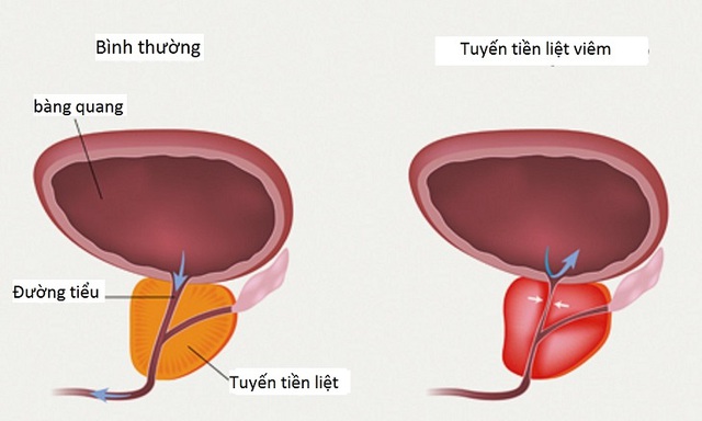 Nguyên nhân đau dạ dày sau quan hệ