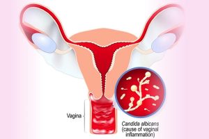 Viêm âm đạo do nấm Candida