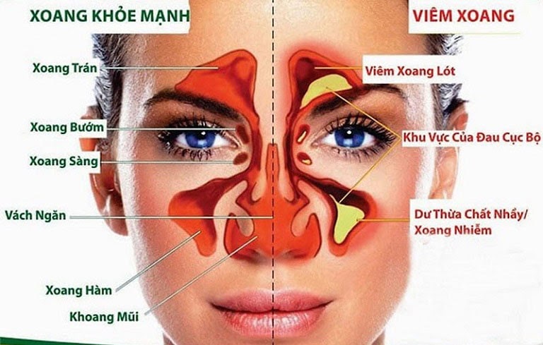 Cách phân biệt các loại viêm xoang thường gặp