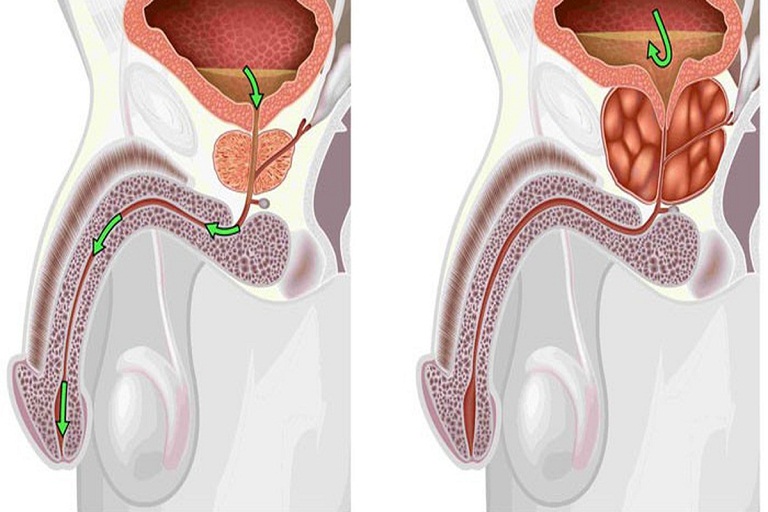 Xuất tinh ra máu có nguy hiểm không